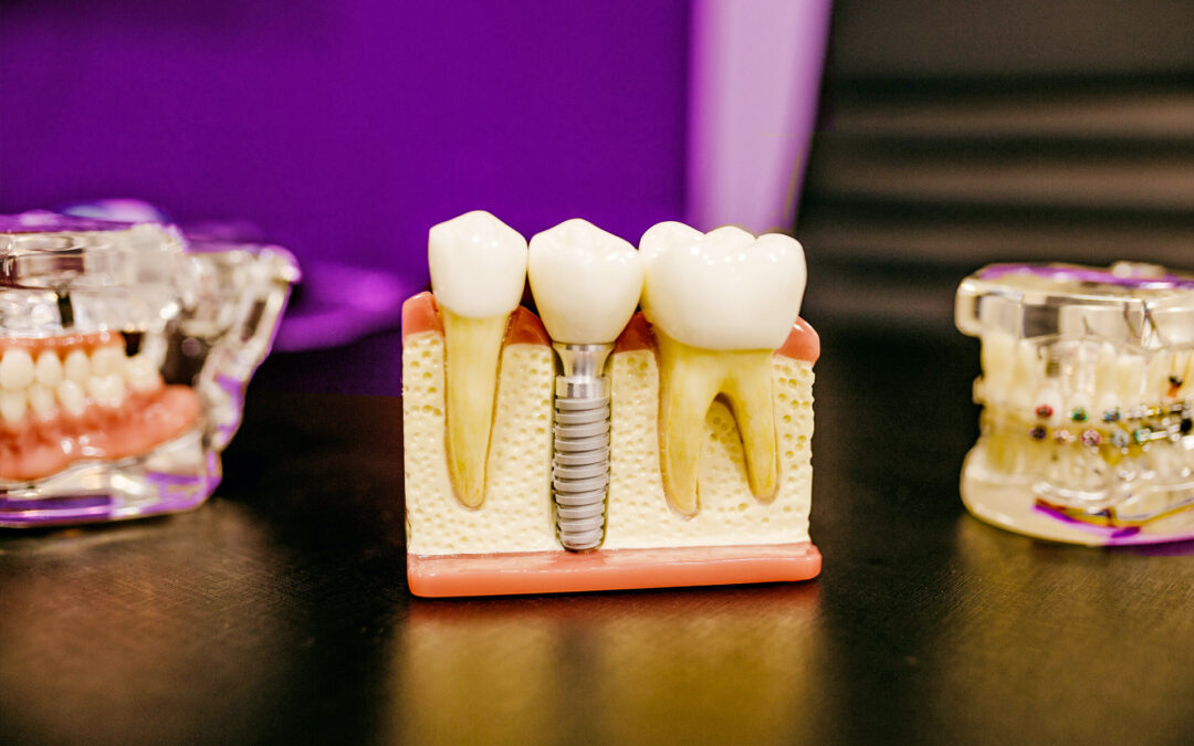 Dental Implants
